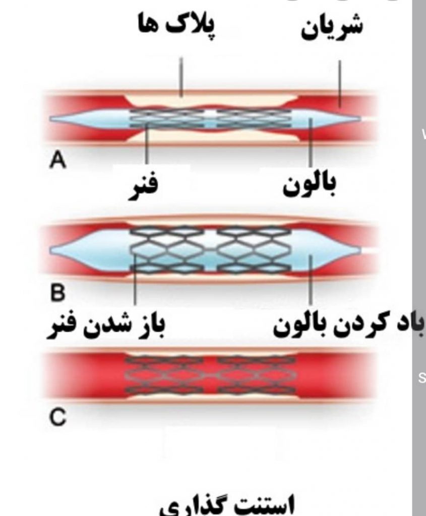 آنژیوپلاستی کاروتید در تهران