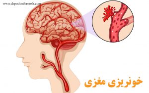خونریزی مغزی