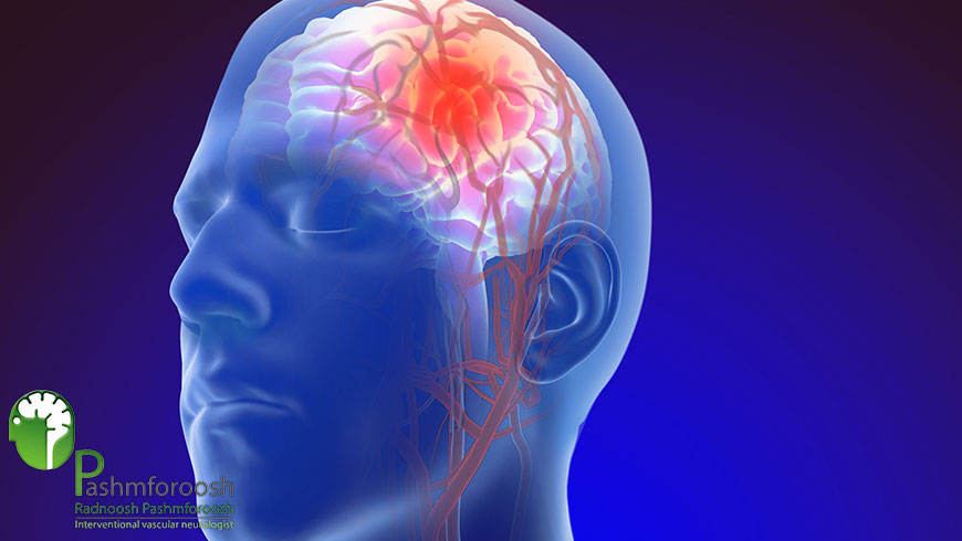 آنژیوگرافی مغزی