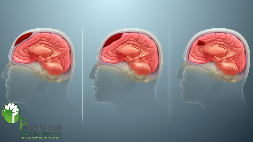 ساب دورال هماتوما چیست