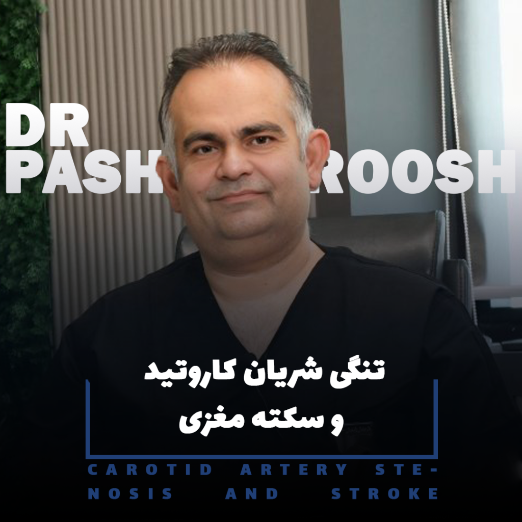 تنگی شریان کاروتید