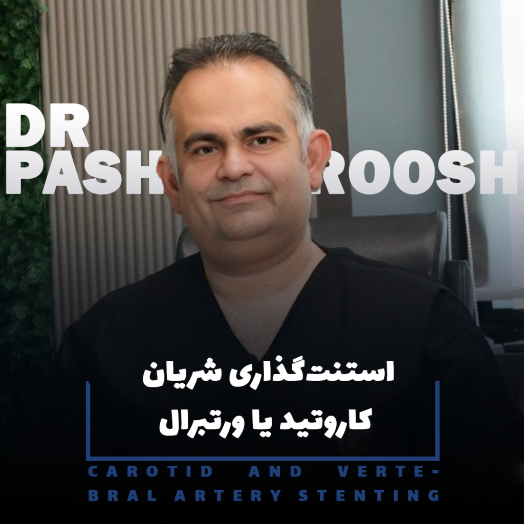 استنت‌گذاری شریان