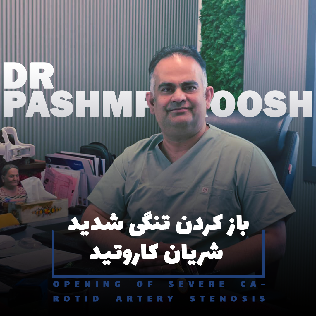 تنگی کاروتید