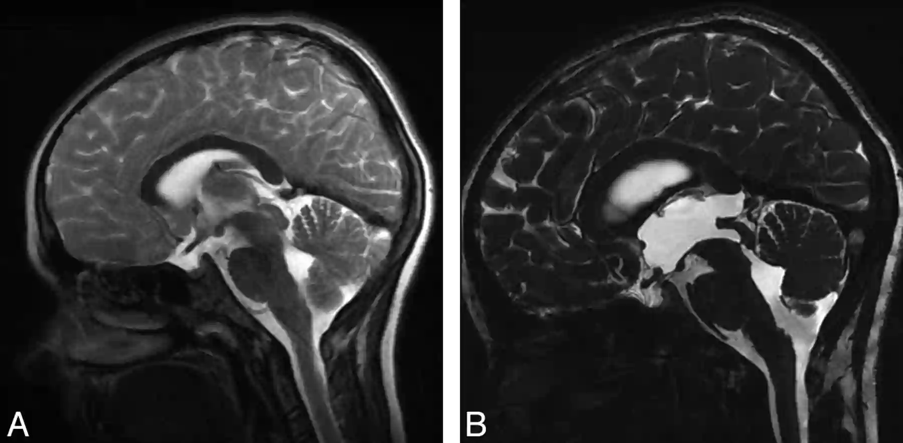 تصویر MRI بیمار مبتلا به هیدروسفالی