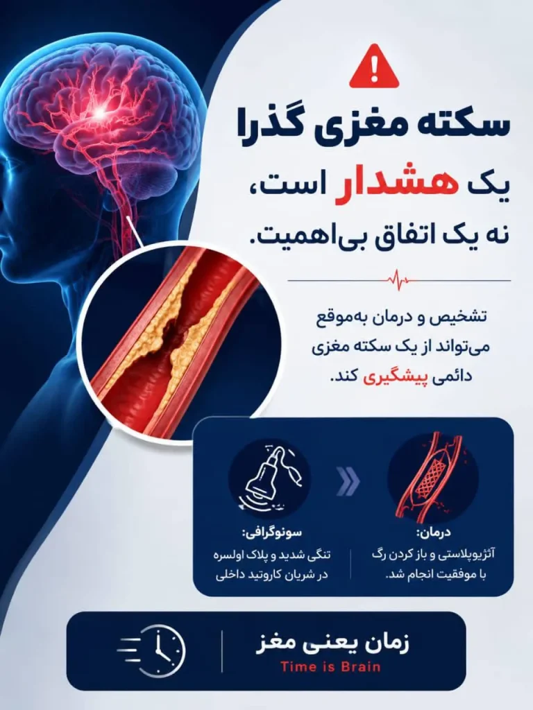 سکته مغزی در جوانان - سکته گذرا