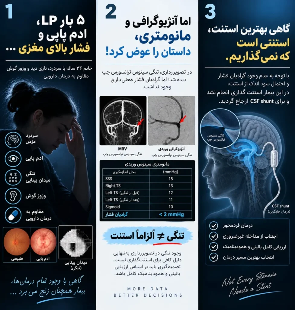 خلاصه تصویری یک بیمار با فشار بالای مغزی و تنگی سینوس ترانسورس چپ: آنژیوگرافی و مانومتری وریدی گرادیان فشار معنیداری نشان نداد و بهجای استنت، شانت CSF انتخاب شد