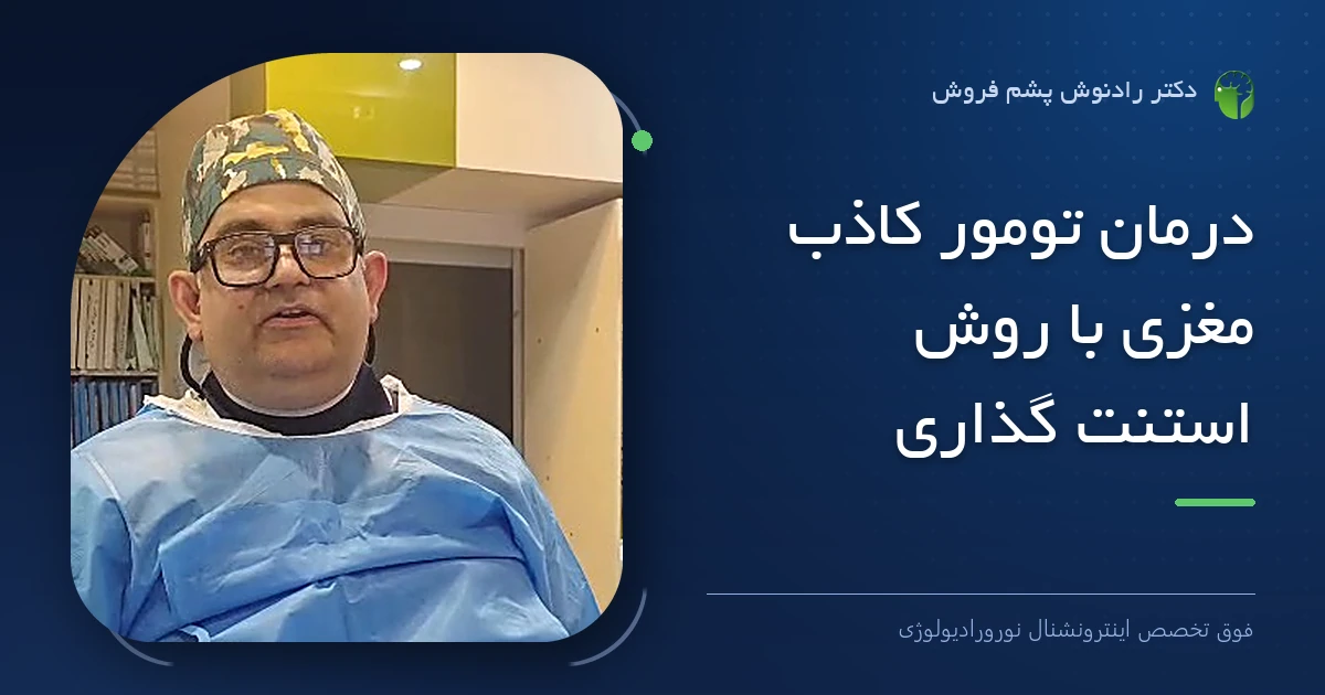 دکتر رادنوش پشم فروش، فوق تخصص اینترونشنال نورورادیولوژی — تصویر شاخص مقاله «درمان تومور کاذب مغزی با روش استنت گذاری»