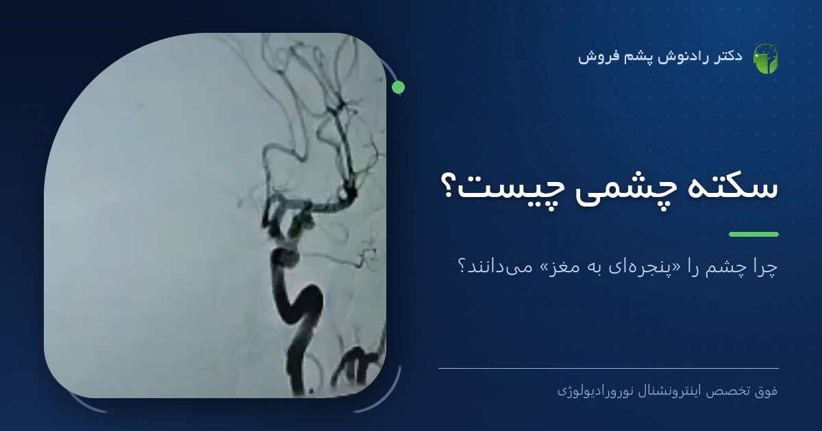 دکتر رادنوش پشم فروش، فوق تخصص اینترونشنال نورورادیولوژی — تصویر آنژیوگرافی شریان کاروتید؛ تصویر شاخص مقاله «سکته چشمی چیست؟»