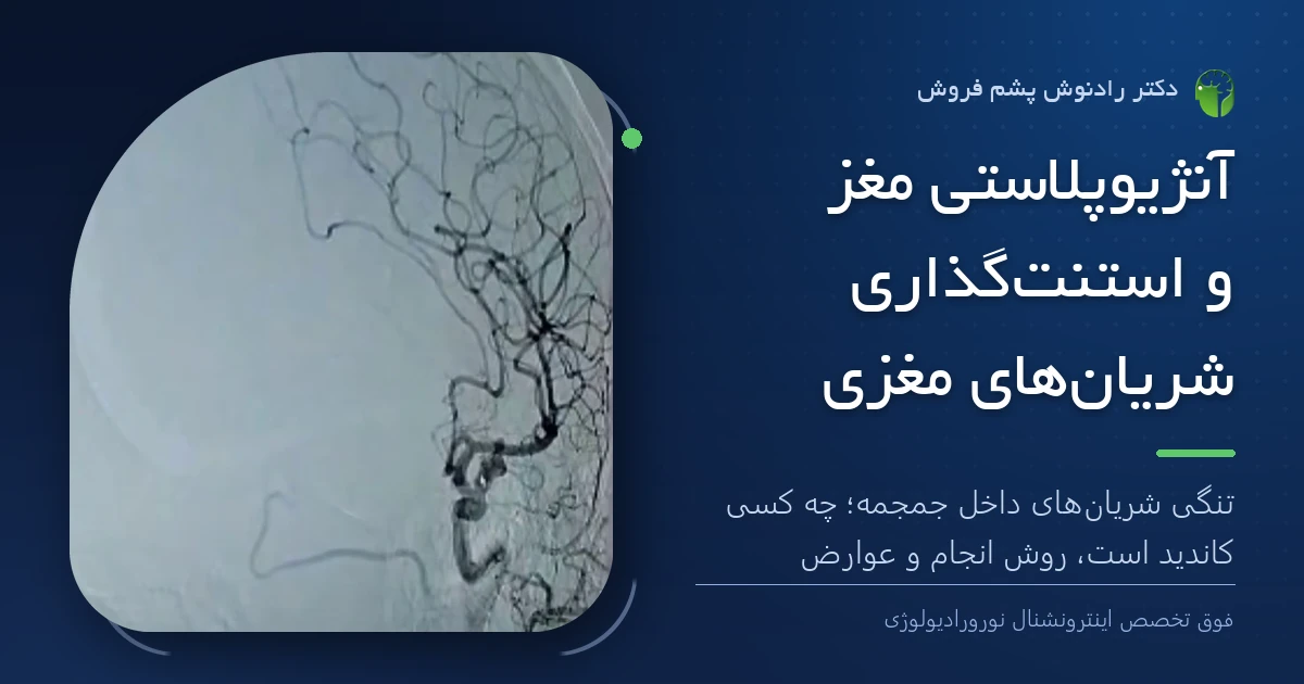 تصویر آنژیوگرافی مغز (DSA) که شریان‌های داخل جمجمه را نشان می‌دهد؛ تصویر شاخص مقاله «آنژیوپلاستی مغز و استنت‌گذاری شریان‌های مغزی» از دکتر رادنوش پشم فروش، فوق تخصص اینترونشنال نورورادیولوژی