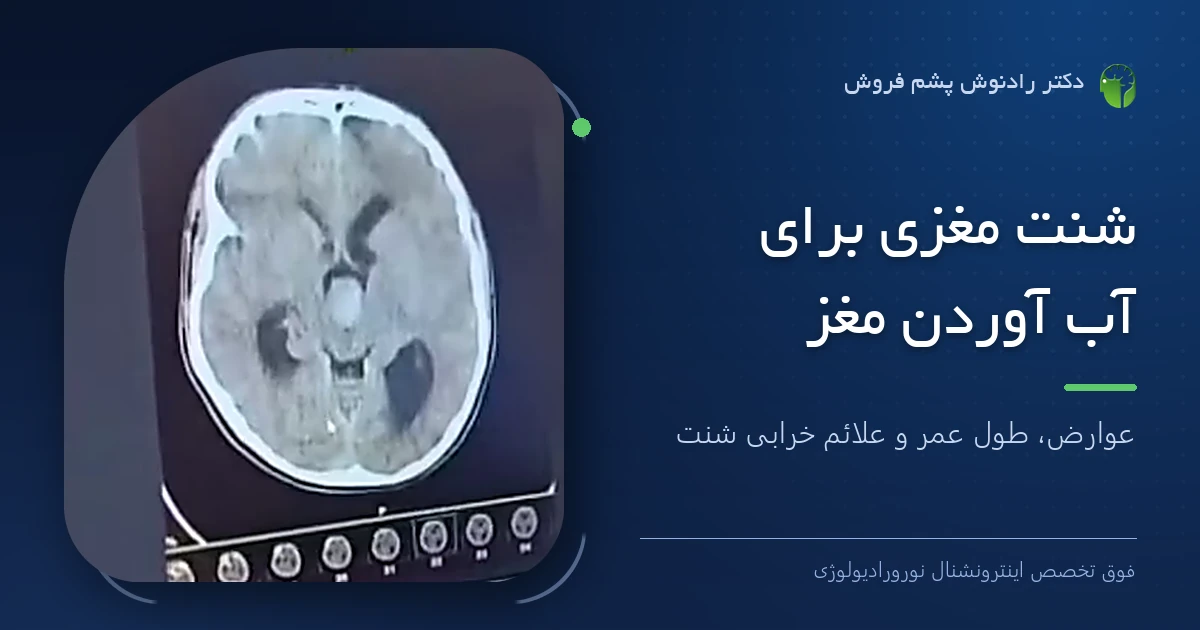 بنر مقاله شنت مغزی؛ تصویر سی‌تی‌اسکن مغز بیمار مبتلا به هیدروسفالی روی مانیتور مطب